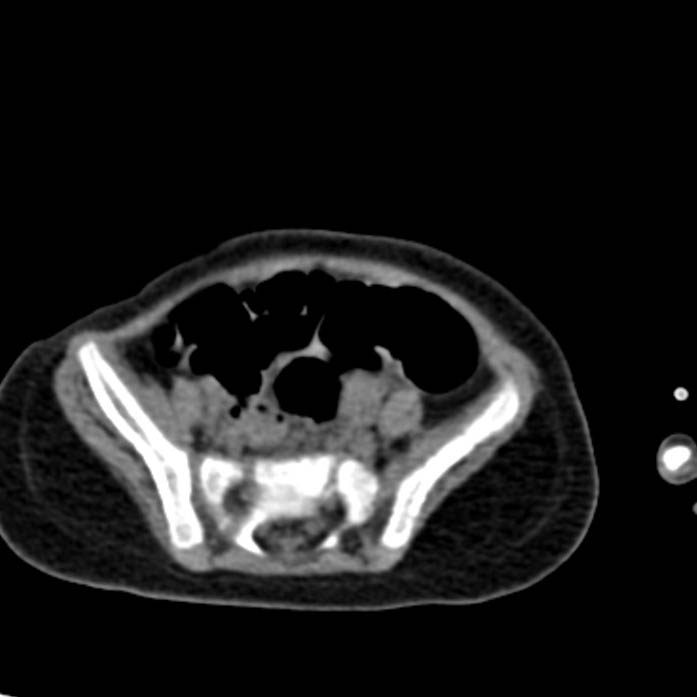 Neuroblastoma with skull metastases (Radiopaedia 30326-30960 Axial non-contrast 47).jpg