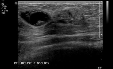 File:Neurofibromatosis of breast (Radiopaedia 5921-7462 G 1).jpg