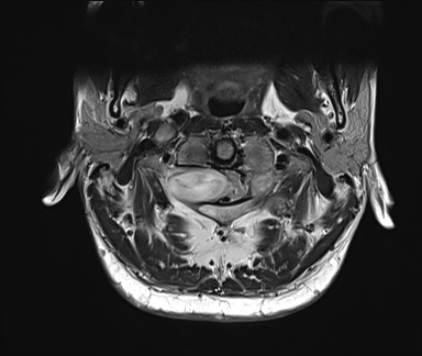 File:Neurofibromatosis type 1 (Radiopaedia 80355-93740 Axial T2 4).jpg