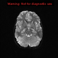 File:Neurofibromatosis type 1 with optic nerve glioma (Radiopaedia 16288-15965 Axial DWI 14).jpg