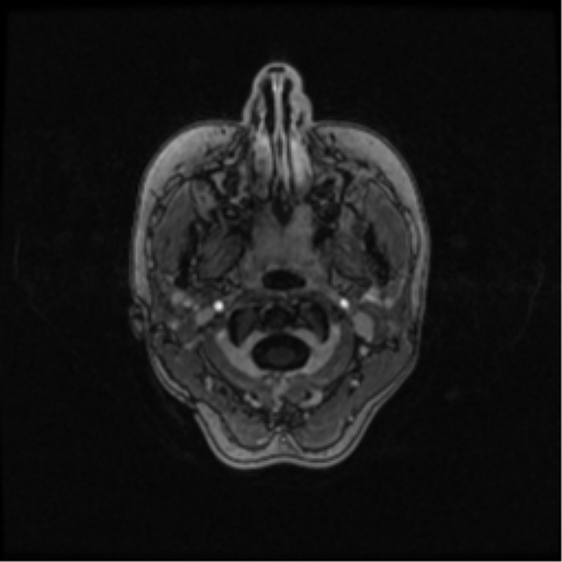 Neurofibromatosis type 2 (Radiopaedia 45229-49244 Axial T1 C+ 15).png