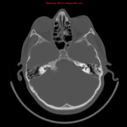 File:Neurofibromatosis type 2 (Radiopaedia 8953-9732 Axial bone window 9).jpg