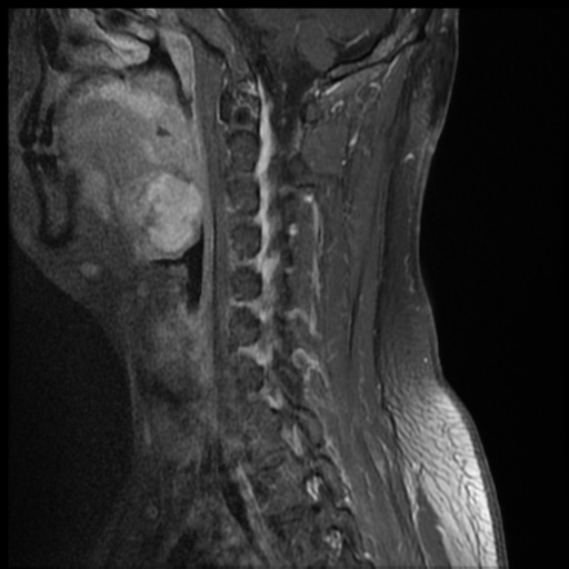 File:Neurofibromatosis type 2 (spinal manifestations) (Radiopaedia 53943-60070 G 4).png