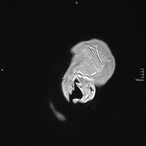 Neurosarcoidosis - involvement of the mesial temporal lobes (Radiopaedia 67429-76820 Sagittal T1 C+ 169).jpg