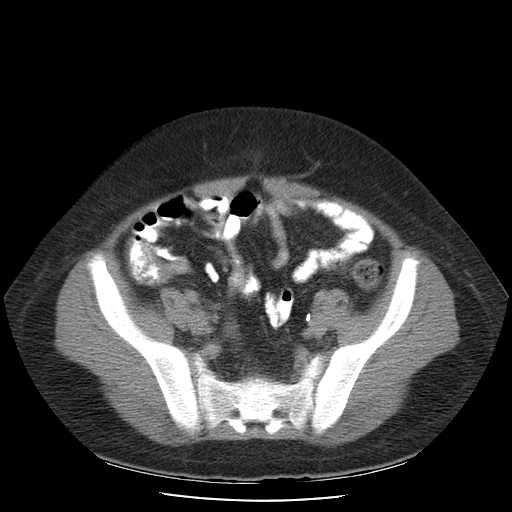 File:Non-Hodgkin lymphoma involving pelvis (Radiopaedia 21281-21197 B 49).jpg
