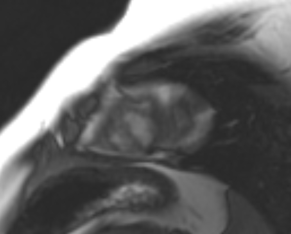 File:Non-compaction of the left ventricle (Radiopaedia 69436-79314 Short axis cine 31).jpg