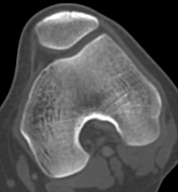 Non-ossifying fibroma - femur (Radiopaedia 82786-97042 Axial bone window 53).jpg