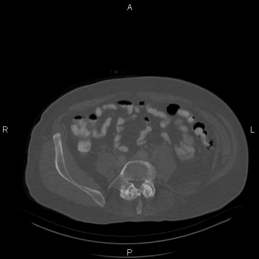 Non Hodgkin lymphoma in a patient with ankylosing spondylitis (Radiopaedia 84323-99624 Axial bone window 49).jpg