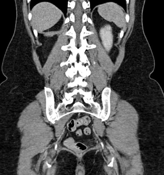 Normal CT intravenous urogram (Radiopaedia 39444-41759 A 343).jpg