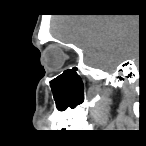 Normal CT paranasal sinuses (Radiopaedia 42286-45390 F 104).jpg