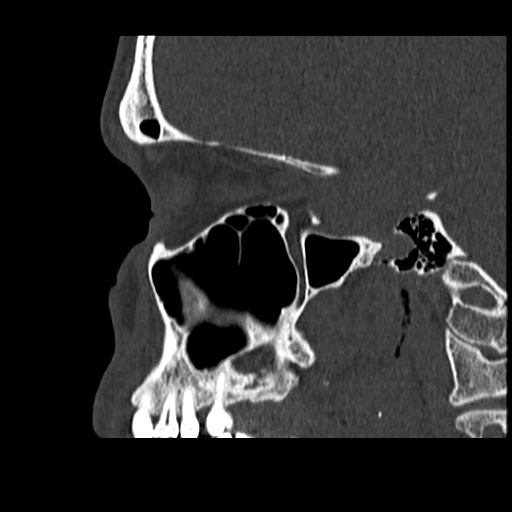 Normal CT paranasal sinuses (Radiopaedia 42286-45390 Sagittal bone window 33).jpg