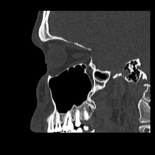 Normal CT paranasal sinuses (Radiopaedia 42286-45390 Sagittal bone window 73).jpg