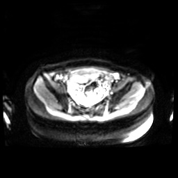 Normal MRI abdomen in pregnancy (Radiopaedia 88001-104541 Axial DWI 8).jpg