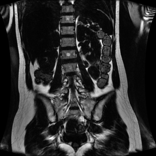 Normal MRI abdomen in pregnancy (Radiopaedia 88001-104541 N 94).jpg