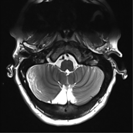 File:Normal MRI cervical spine (infection protocol) (Radiopaedia 53916-60039 Axial T2 3).png