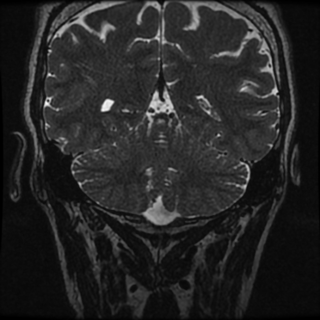 Normal MRI petrous (Radiopaedia 91317-108949 Coronal T2 106).jpg