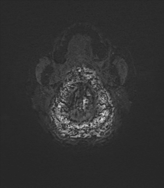Normal brain MRI (TLE protocol) (Radiopaedia 40748-43405 Axial SWI 88).png