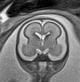 File:Normal brain fetal MRI - 22 weeks (Radiopaedia 50623-56050 Coronal T2 Haste 14).jpg