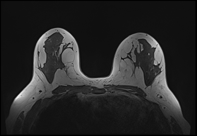 File:Normal breast MRI - dense breasts (Radiopaedia 80454-93850 Axial T1 117).jpg