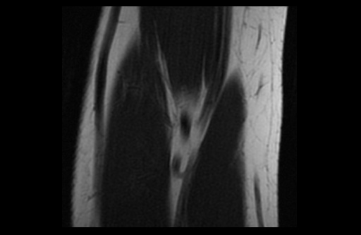 File:Normal elbow arthrograms (Radiopaedia 75550-86805 Coronal T1 16).jpg