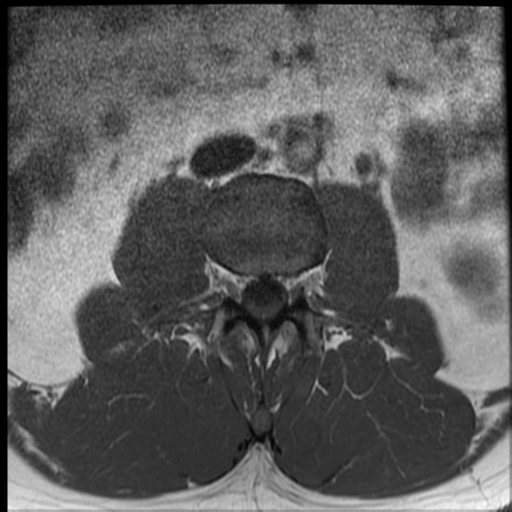File:Normal lumbar spine MRI (Radiopaedia 35543-37039 Axial T1 29).png