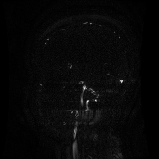 Normal noncontrast MR venography (Radiopaedia 87578-103957 A 118).jpg