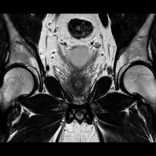 File:Normal prostate (MRI) (Radiopaedia 29986-30535 Coronal T2 9).jpg
