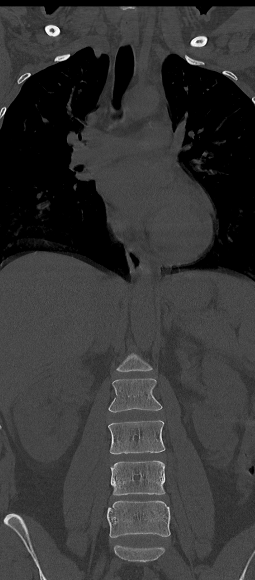 Normal thoracolumbar spine (Radiopaedia 43822-47309 Coronal bone window 35).png