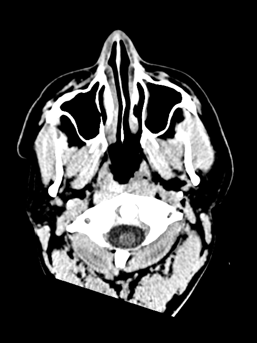 Normal trauma protocol brain and C-spine CT (Radiopaedia 83302-97709 Axial non-contrast 71).jpg