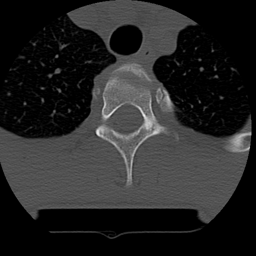 File:Normal trauma spine imaging (age 16) (Radiopaedia 45335-49358 Axial bone window 89).jpg