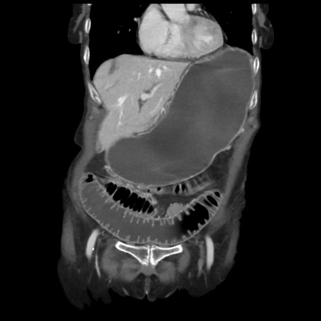 Obstructed obturator hernia (Radiopaedia 75197-86293 B 16).jpg