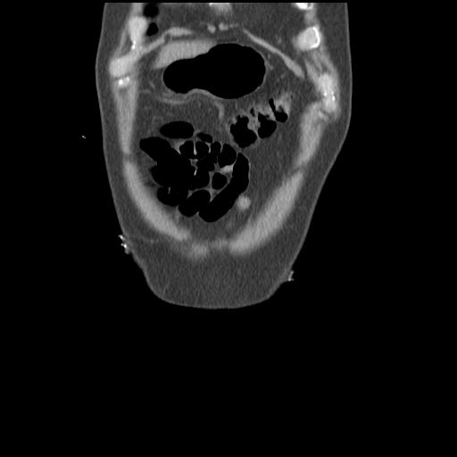 Obstructing renal calculus (Radiopaedia 29517-30016 Coronal non-contrast 6).jpg