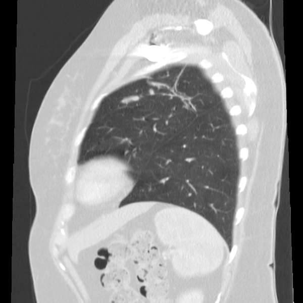 Obstructing typical carcinoid causing bronchoceles (Radiopaedia 50149-55476 Sagittal lung window 46).png