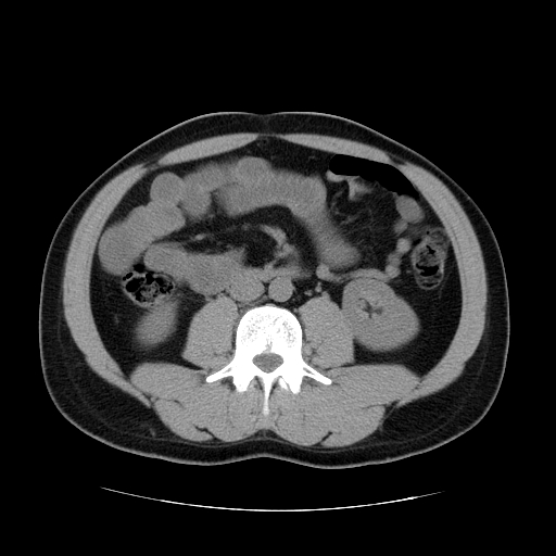 File:Obstructing ureteric calculus (Radiopaedia 18615-18514 Axial non-contrast 29).jpg