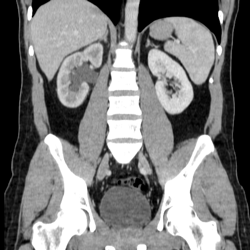 File:Obstructing ureteric calculus (Radiopaedia 18615-18514 C 48).jpg