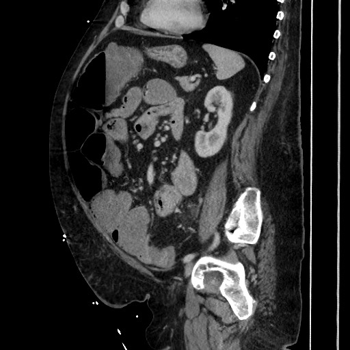 Obstructive colonic diverticular stricture (Radiopaedia 81085-94675 C 153).jpg
