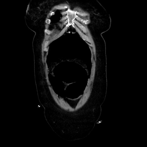 Obstructive distal colonic adenocarcinoma causing cecal perforation (Radiopaedia 86830-102989 C 47).jpg
