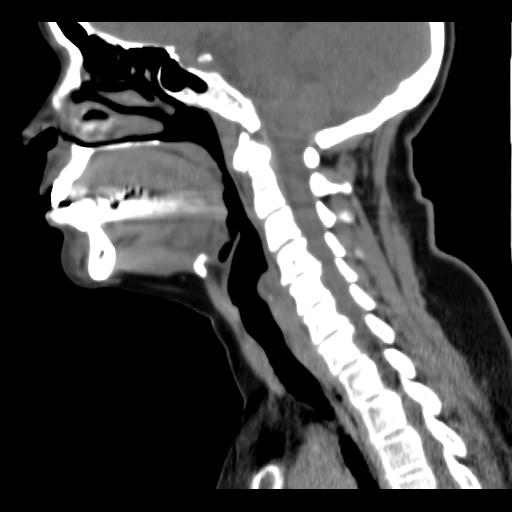 File:Obstructive sleep apnea (CT evaluation) (Radiopaedia 24304-24582 C 40).jpg