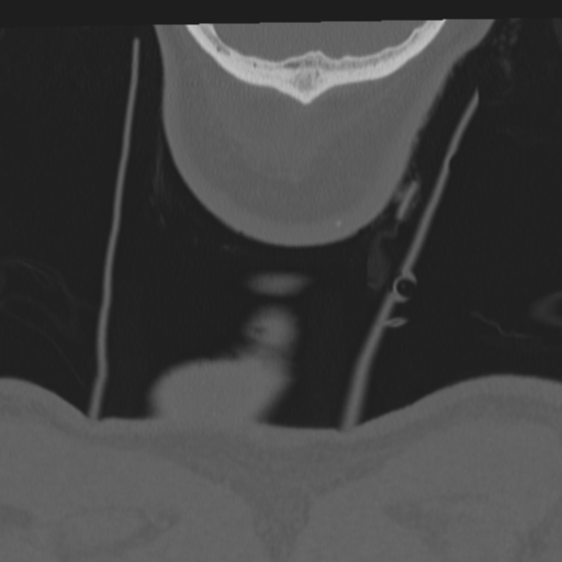 File:Occipital condyle fracture (Radiopaedia 33467-34517 Coronal bone window 85).png