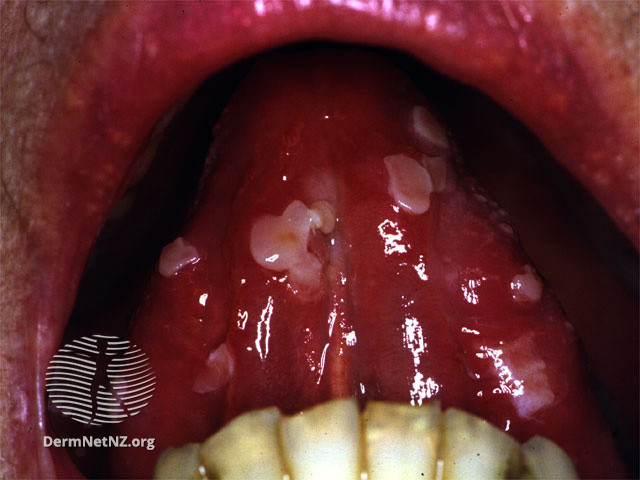 File:Oral pemphigus vulgaris (DermNet NZ immune-pgus1).jpg