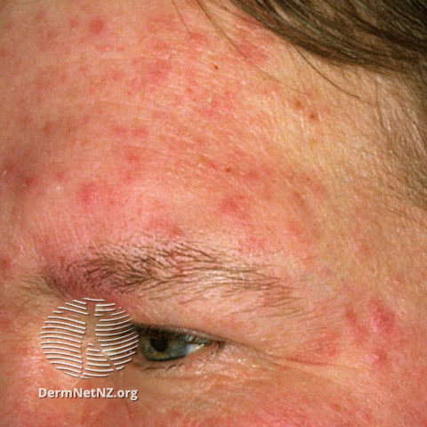 Rosacea (DermNet NZ acne-red-face-3605).jpg