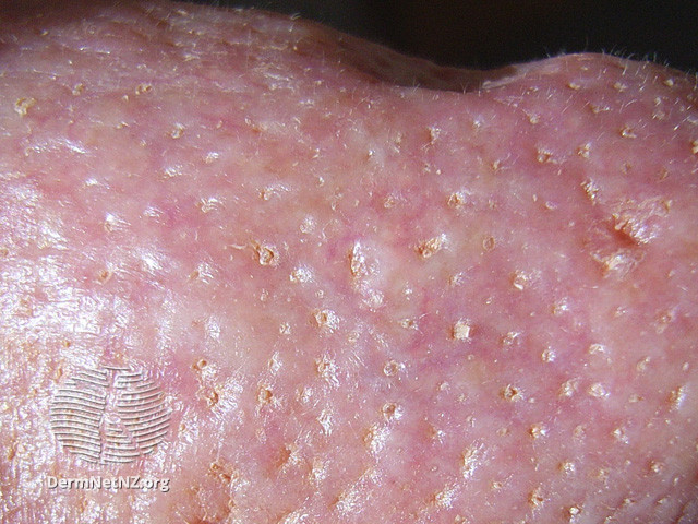 Rosacea (DermNet NZ acne-red-face-3636).jpg