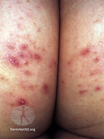 File:Superficial bacterial folliculitis (DermNet NZ acne-folliculitis1).jpg