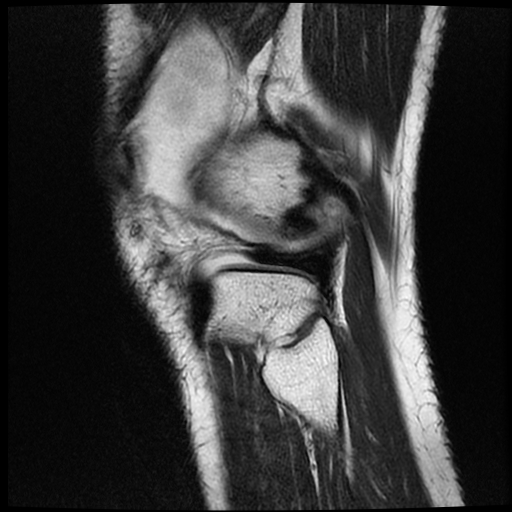 File:ACL acute full thickness tear - deep lateral femoral sulcus sign (Radiopaedia 38594-40740 Sagittal T2 19).jpg