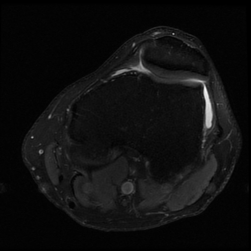File:ACL and meniscal tears (Radiopaedia 79604-92797 Axial PD fat sat 9).jpg