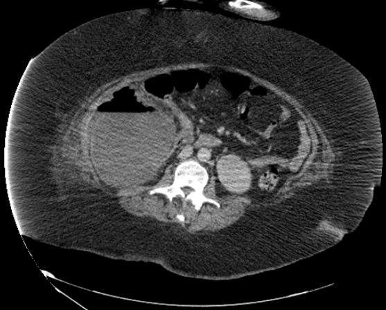 File:Abdominal abscess - pre and post percutaneous drainage (Radiopaedia 60209-67816 Axial 3).png