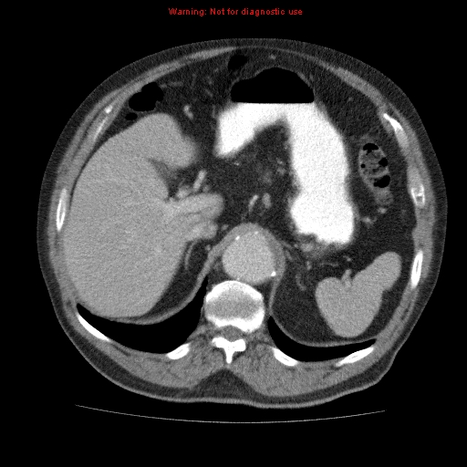 Abdominal aortic aneurysm (Radiopaedia 10122-10660 Axial C+ portal venous phase 18).jpg