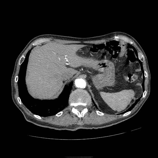 Abdominal aortic aneurysm (Radiopaedia 13341-13340 Axial C+ arterial phase 32).jpg