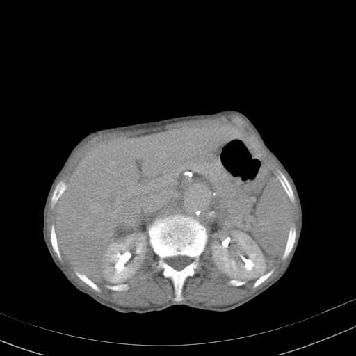 File:Abdominal aortic aneurysm (Radiopaedia 20827-20742 Axial C+ delayed 8).jpg