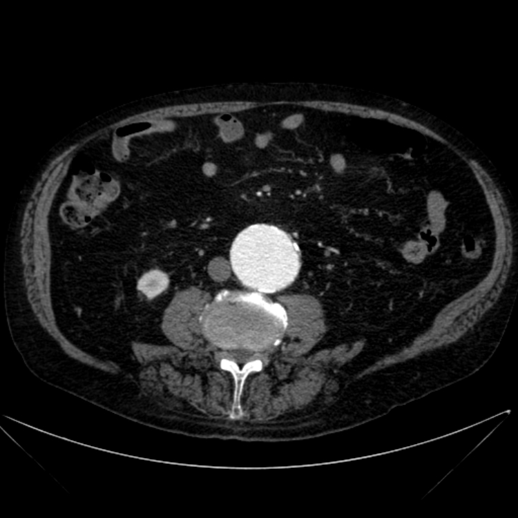 Abdominal aortic aneurysm (Radiopaedia 25855-26001 Axial C+ arterial phase 74).jpg